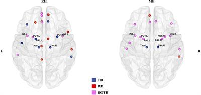 Disrupted Subcortical-Cortical Connections in a Phonological but Not Semantic Task in Chinese Children With Dyslexia